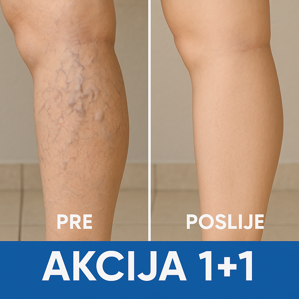 Flasteri za Vene AKCIJA 1+1 GRATIS